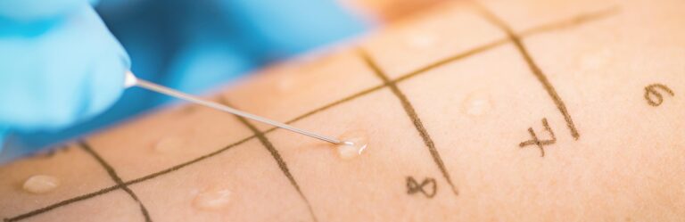 A close-up of a skin allergy test on an arm, with a needle applying substances. The skin is marked with a grid, and small raised bumps are visible at some grid points.