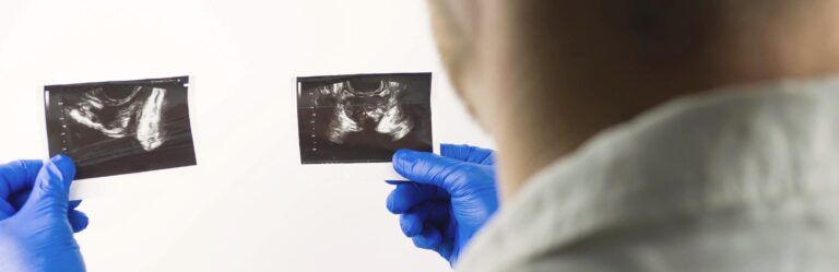 A person wearing blue gloves holds and examines two ultrasound images with a light background.